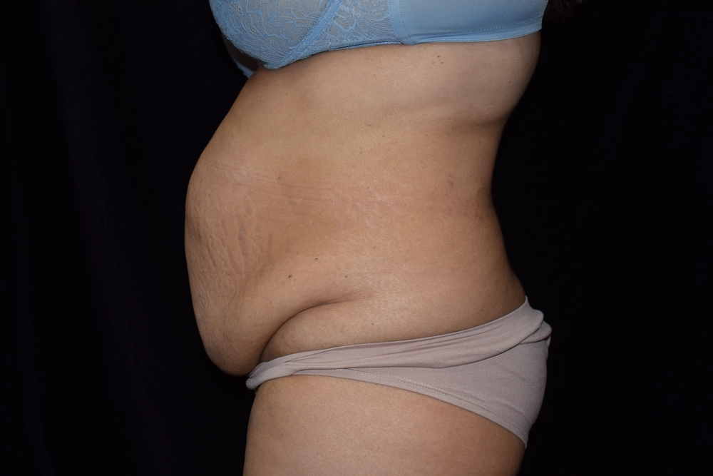 tummy-tuck Before Photo for Patient #3