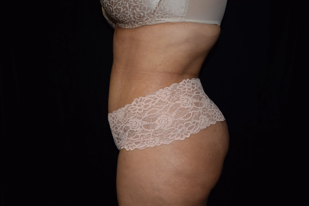 tummy-tuck After Photo for Patient #3