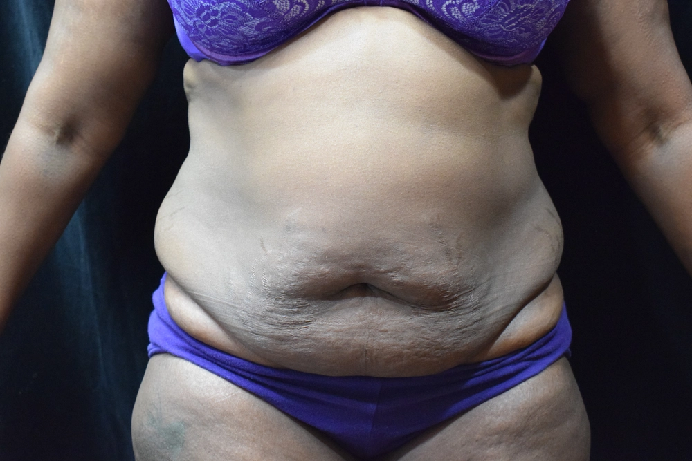 tummy-tuck Before Photo for Patient #4