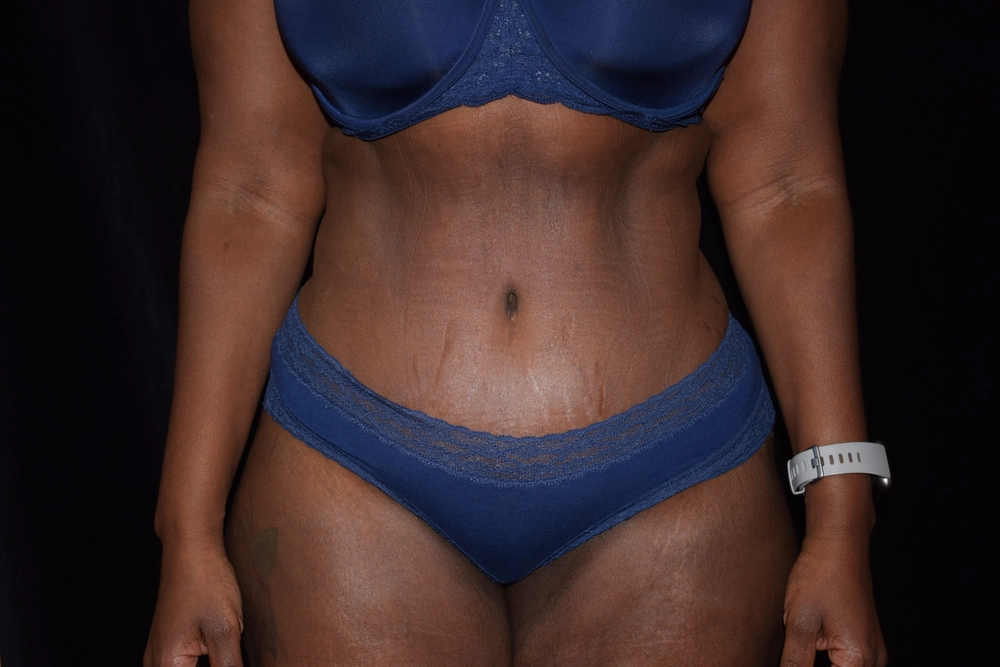 tummy-tuck After Photo for Patient #4