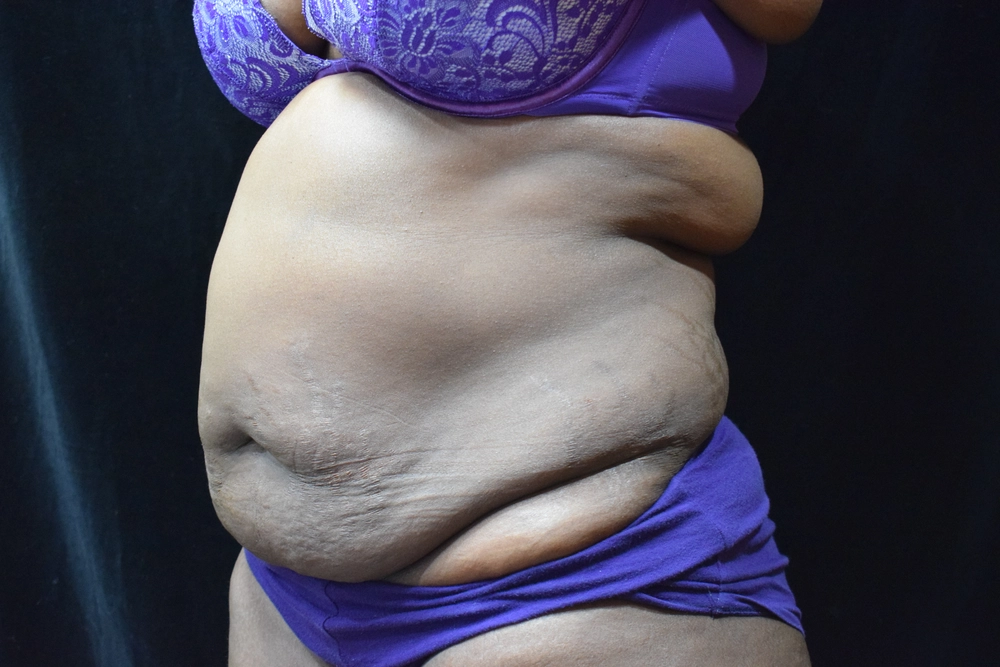 tummy-tuck Before Photo for Patient #4