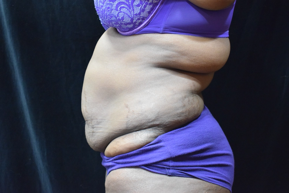 tummy-tuck Before Photo for Patient #4