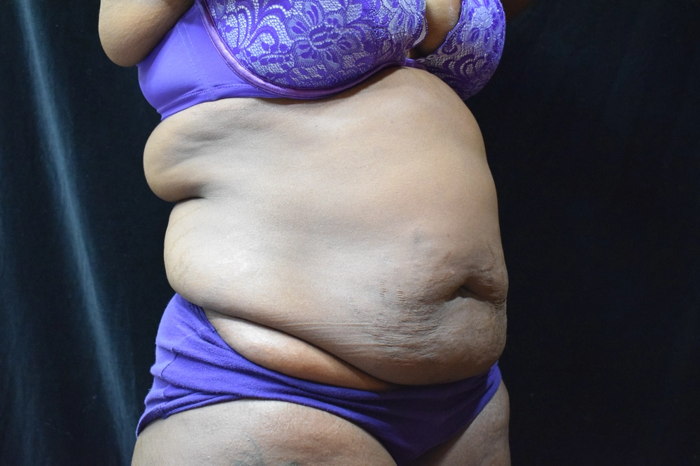 tummy-tuck Before Photo for Patient #4