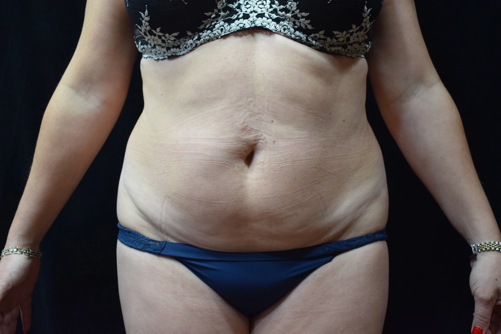tummy-tuck Before Photo for Patient #5