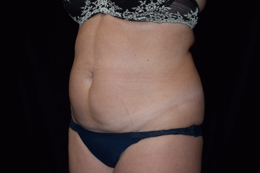 tummy-tuck Before Photo for Patient #5