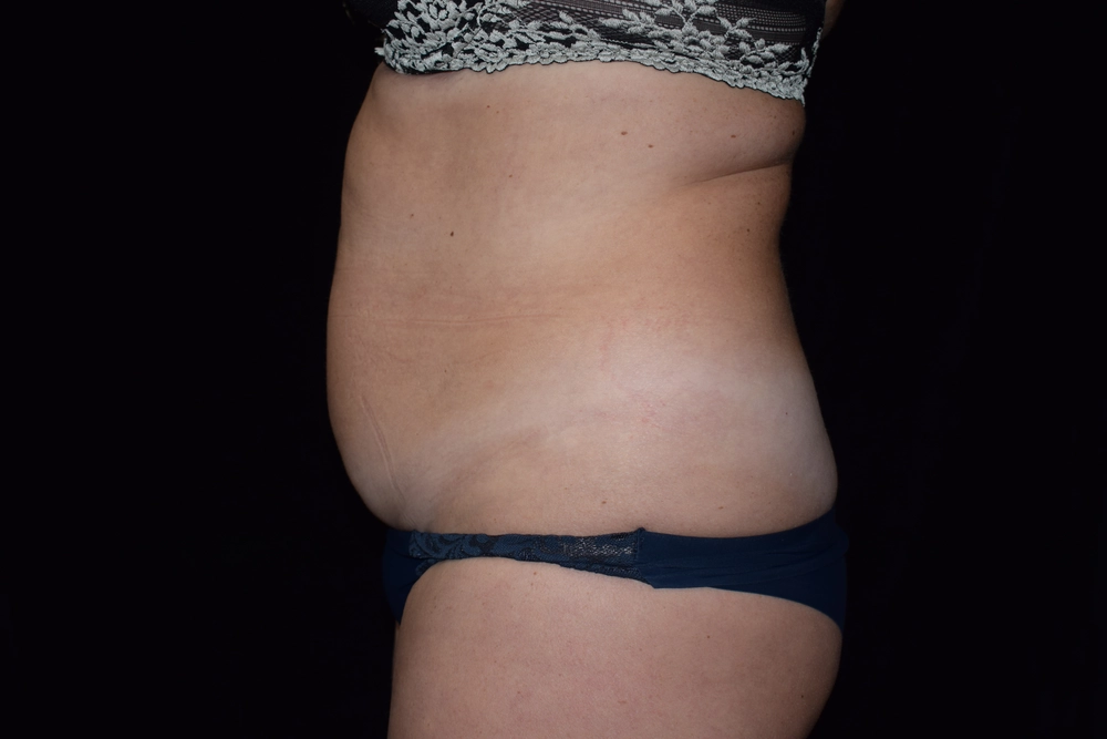 tummy-tuck Before Photo for Patient #5