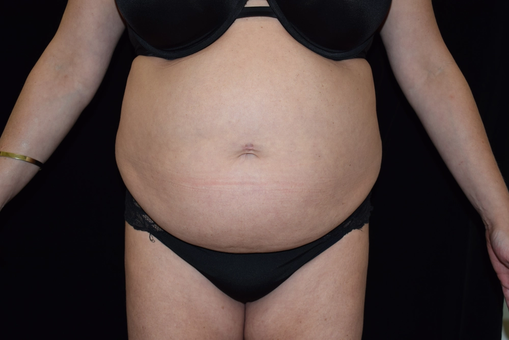 tummy-tuck Before Photo for Patient #6