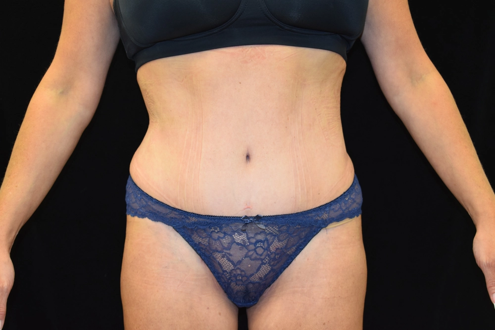 tummy-tuck After Photo for Patient #6