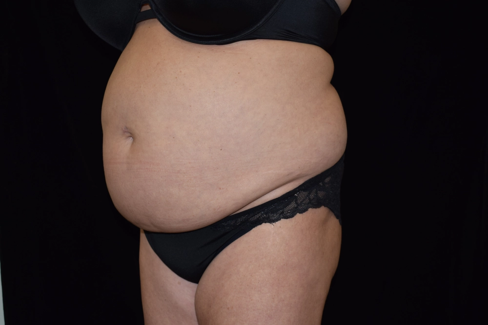 tummy-tuck Before Photo for Patient #6