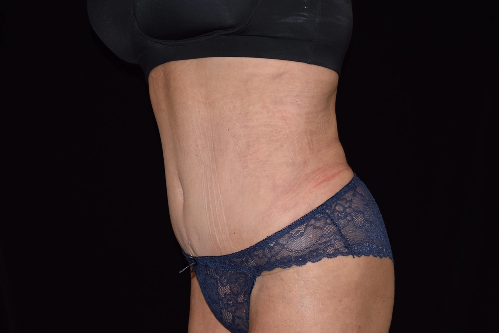 tummy-tuck After Photo for Patient #6