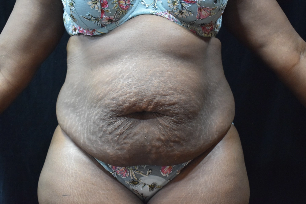 tummy-tuck Before Photo for Patient #7