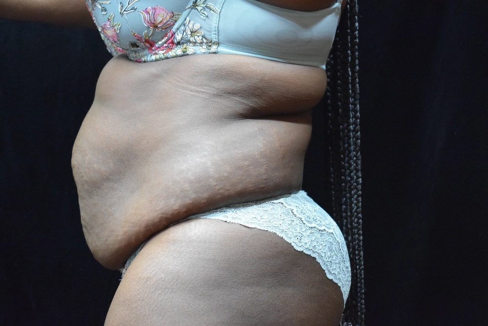 tummy-tuck Before Photo for Patient #7