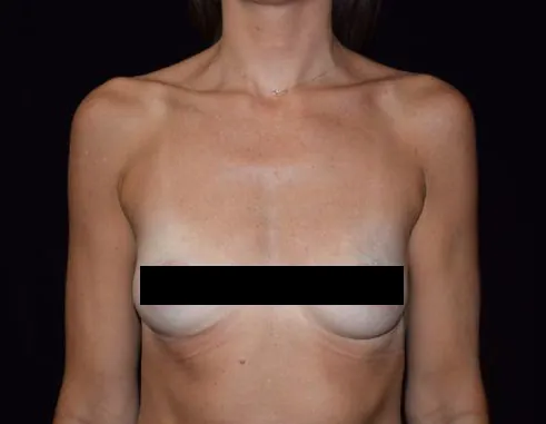 Image of patient before breast implant/augmentation plastic surgery procedure