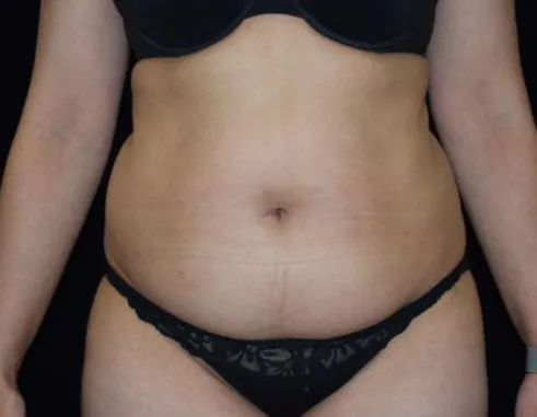 Image of patient before liposuction plastic surgery procedure