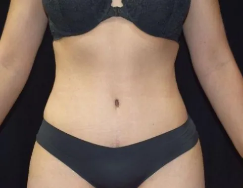 Image of patient after liposuction plastic surgery procedure