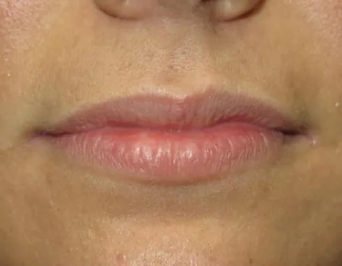 Image of patient before blepharoplasty plastic surgery procedure