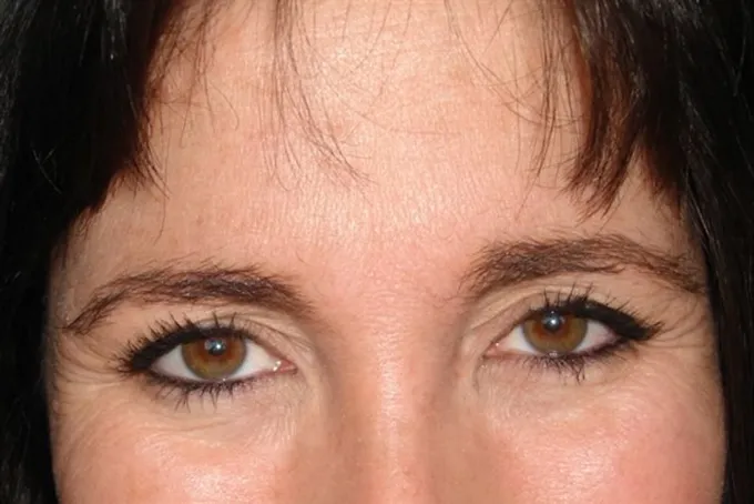 before-after-botox-55a
