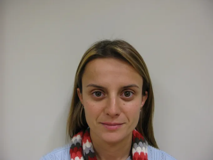 before-after-botox-66b
