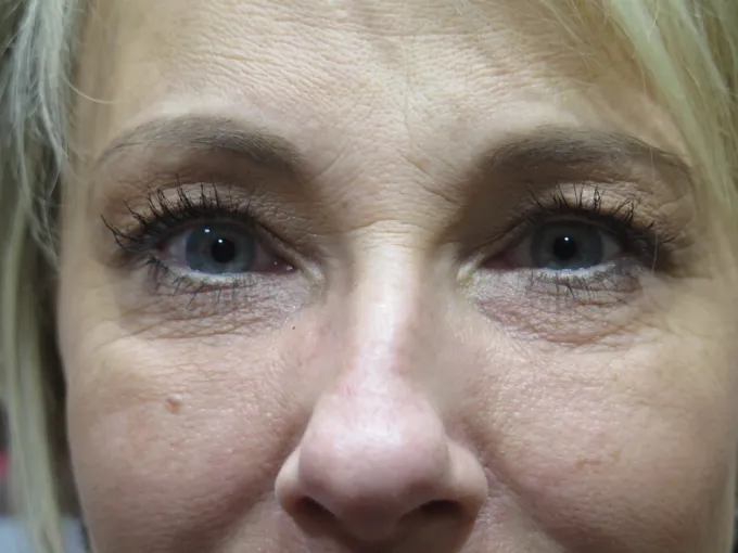 before-after-cheek-augmentation-33b
