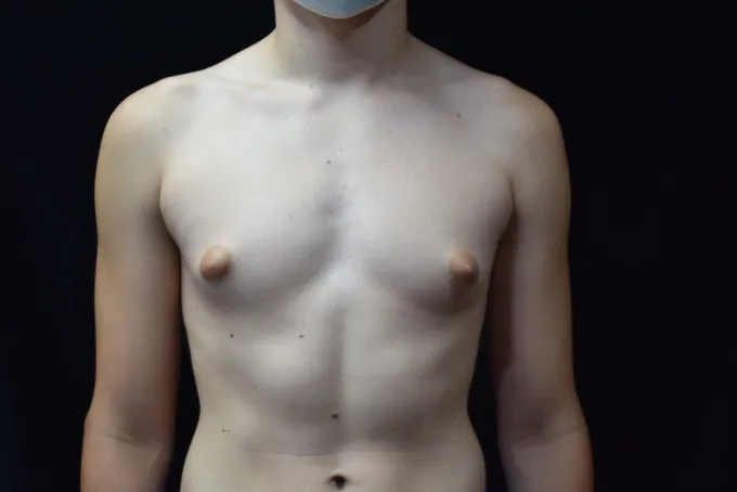 before-after-gynecomastia--11a