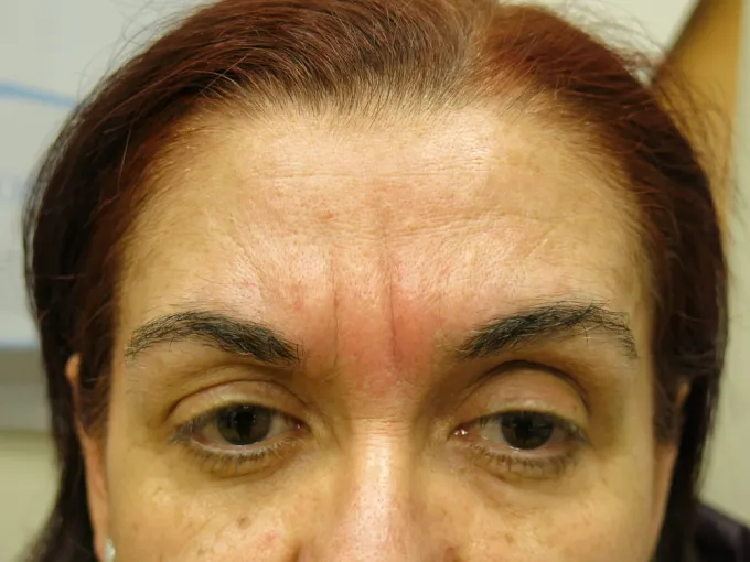 before-after-injectable-glabella-22a