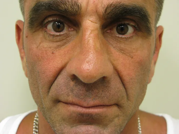 before-after-nasolabial-folds-11a