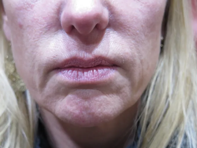 before-after-nasolabial-folds-33a