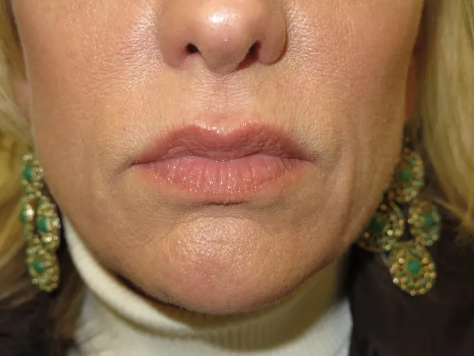 before-after-nasolabial-folds-33b