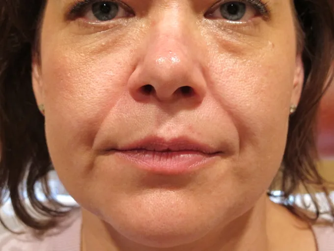 before-after-nasolabial-folds-44a