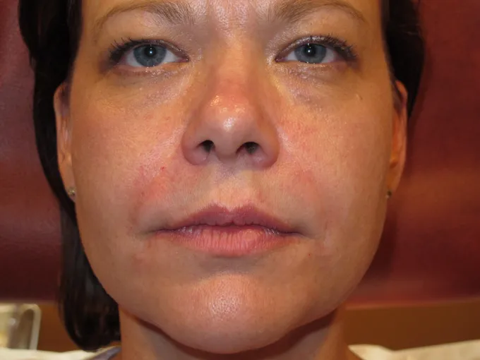 before-after-nasolabial-folds-44b
