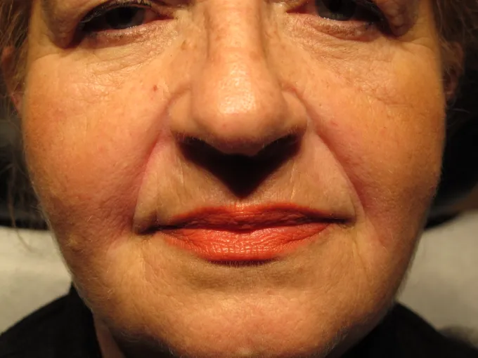 before-after-nasolabial-folds-55a