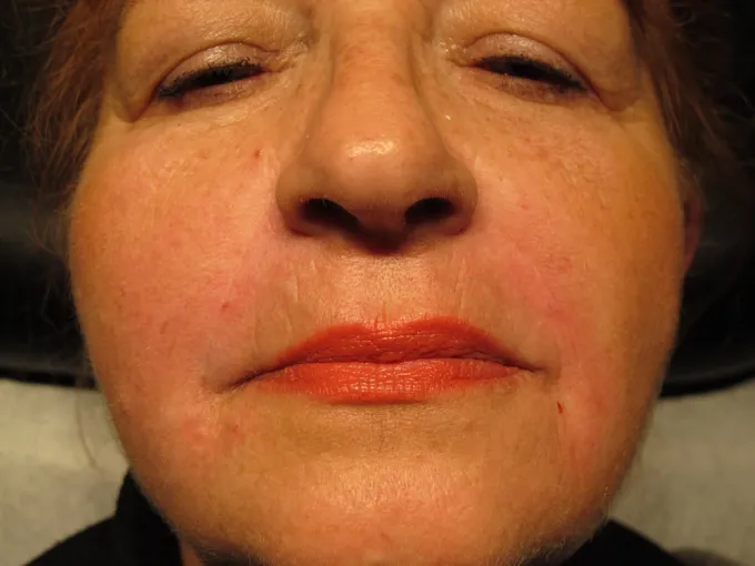 before-after-nasolabial-folds-55b