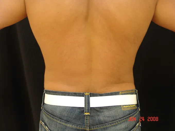 After-liposuction Last