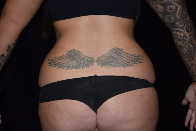 before-after-liposuction-99a