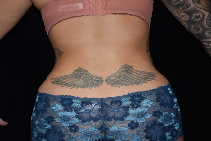 before-after-liposuction-1010b