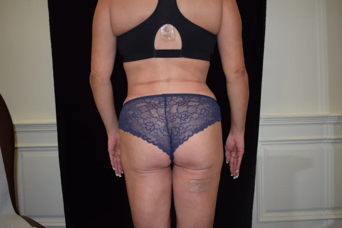 before-after-liposuction-1111b