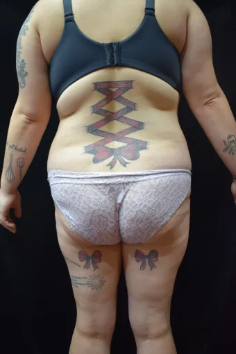 before-after-liposuction-1212a
