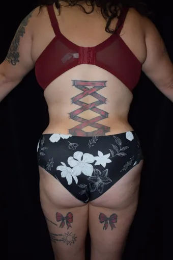 before-after-liposuction-1111b