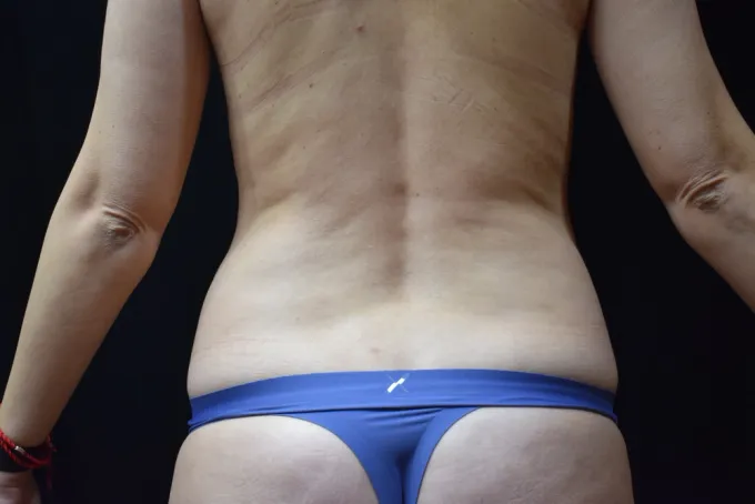 before-after-liposuction-1212a