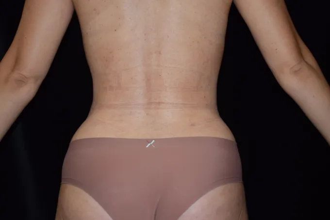before-after-liposuction-1111b