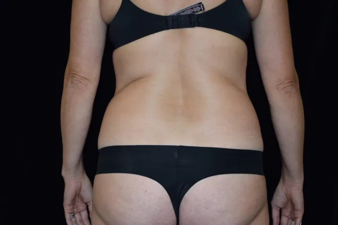 before-after-liposuction-1212a