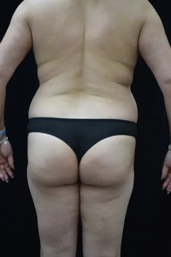before-after-liposuction-1212a