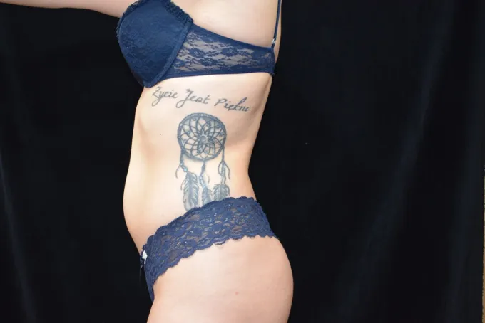 before-after-liposuction-33e