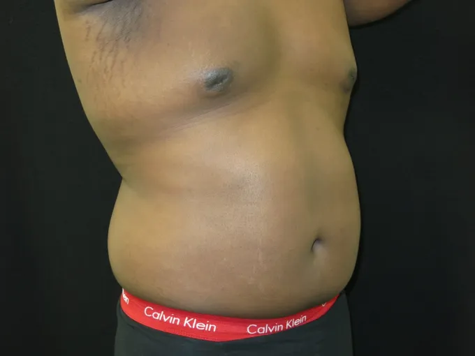 before-after-liposuction-66c