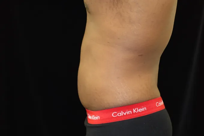 before-after-liposuction-66j