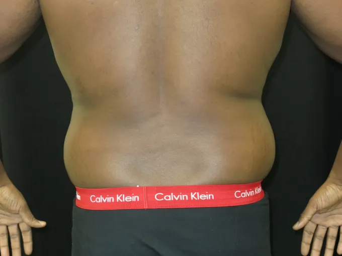 before-after-liposuction-66i