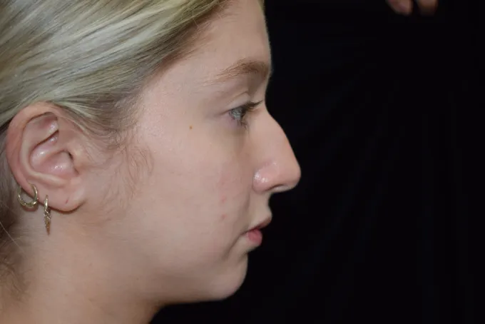 before-after-rhinoplasty-11c