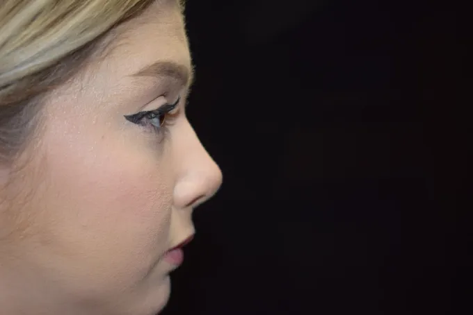 before-after-rhinoplasty-11d