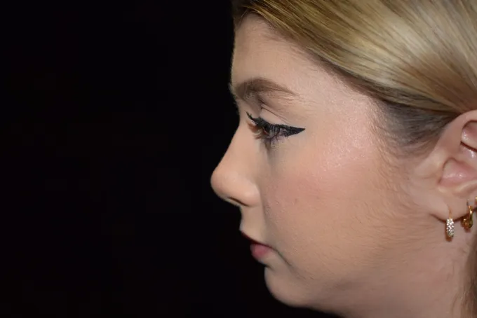 before-after-rhinoplasty-11f