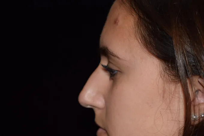 before-after-rhinoplasty-22c